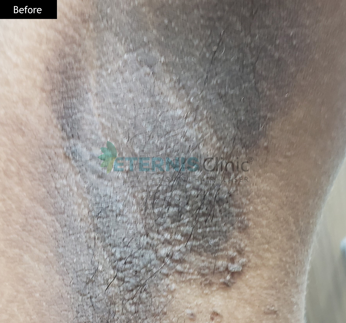Before: Underarm pigmentation, 4 sessions