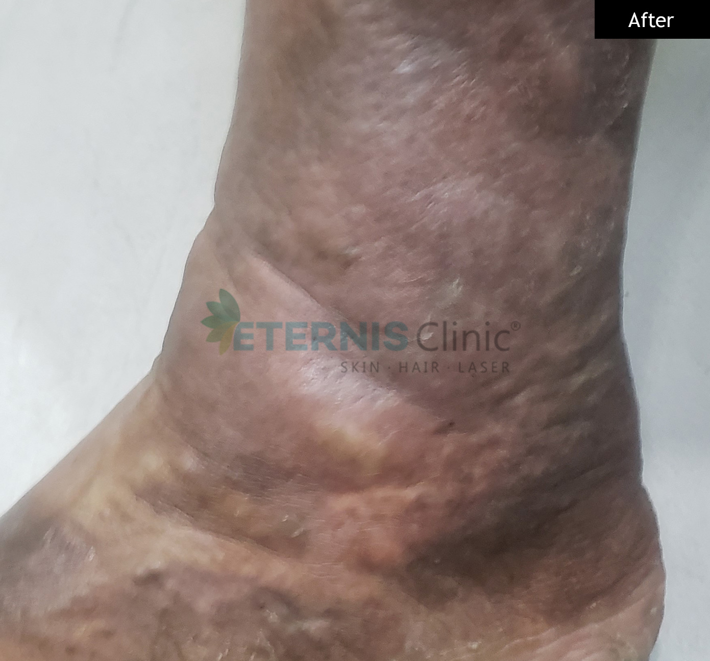 After: Atopic eczema, 6 weeks of care