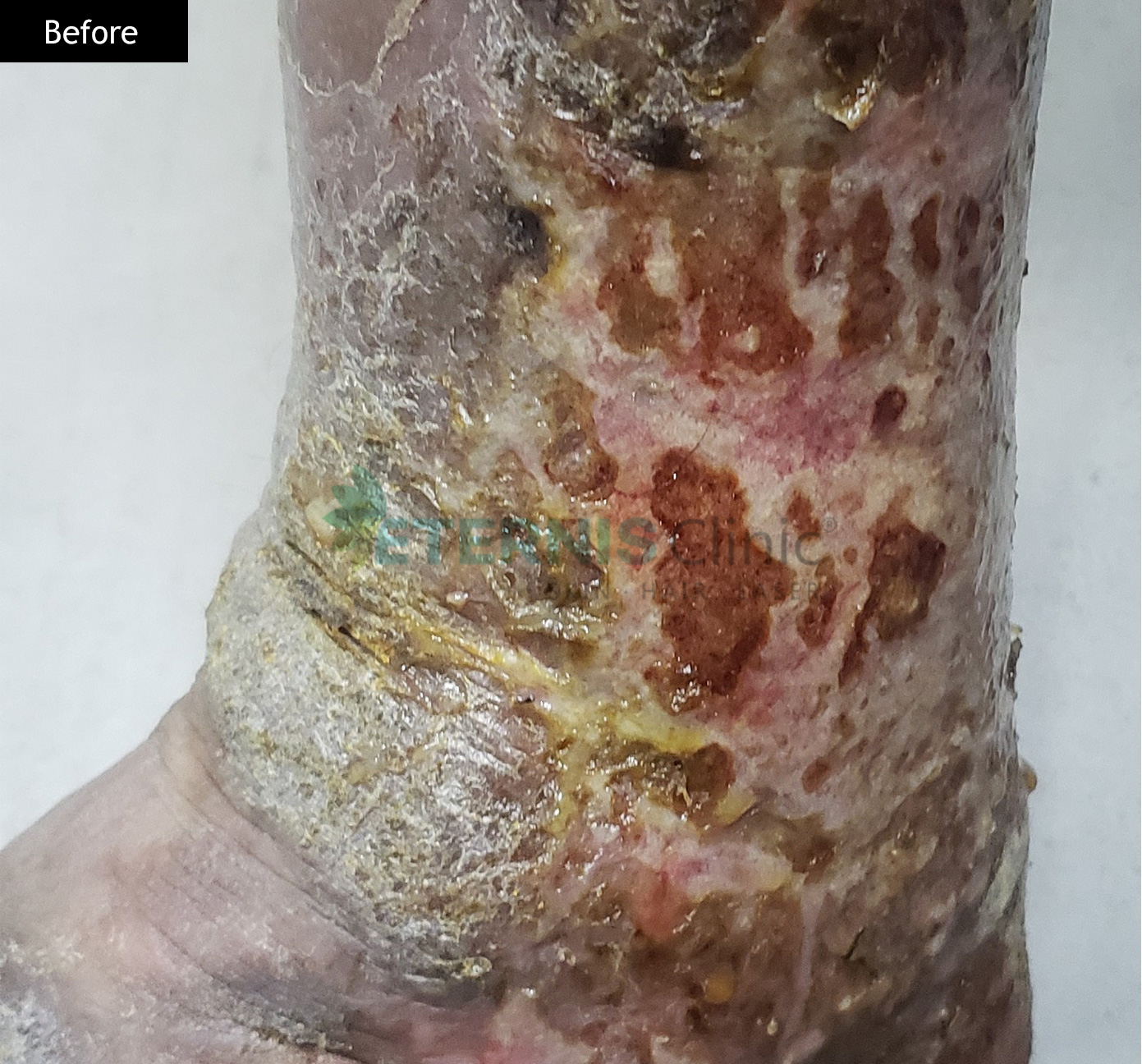 Before: Atopic eczema, 6 weeks of care