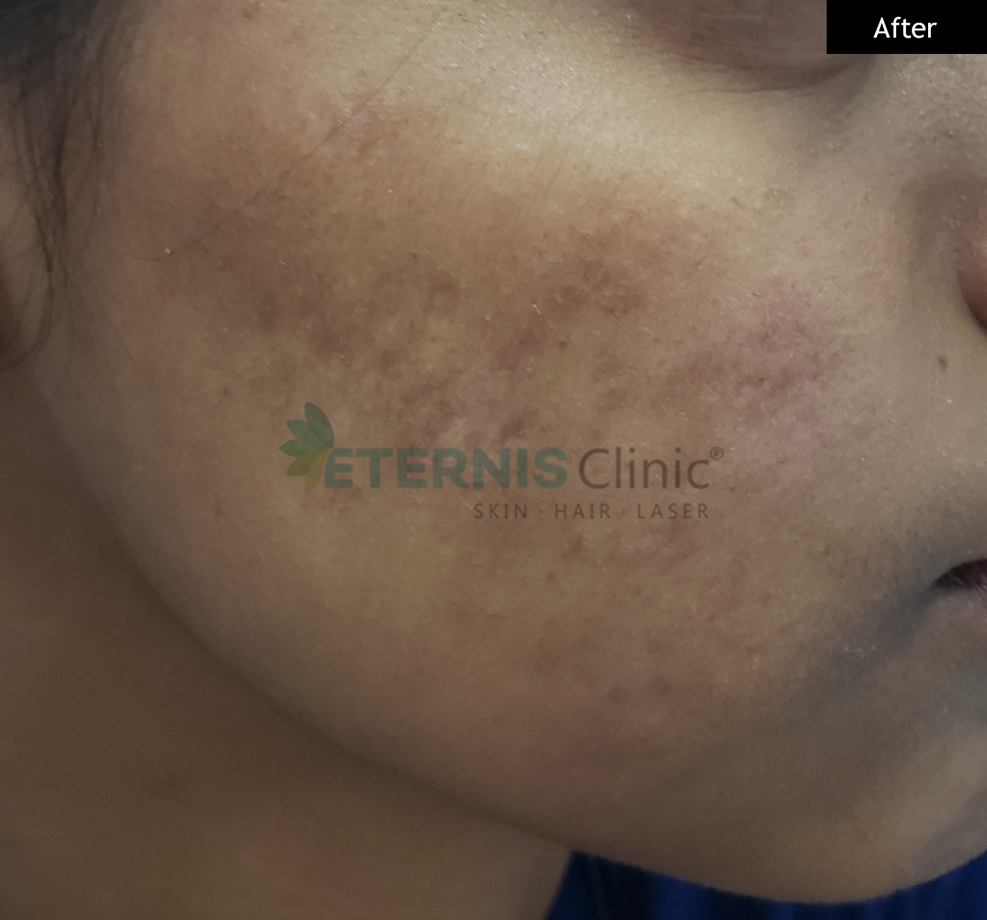 After: Active acne, marked clearance after 12 weeks