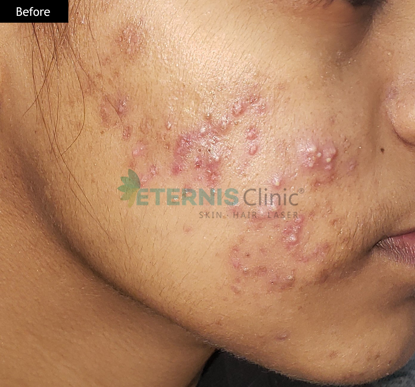 Before: Active acne, marked clearance after 12 weeks