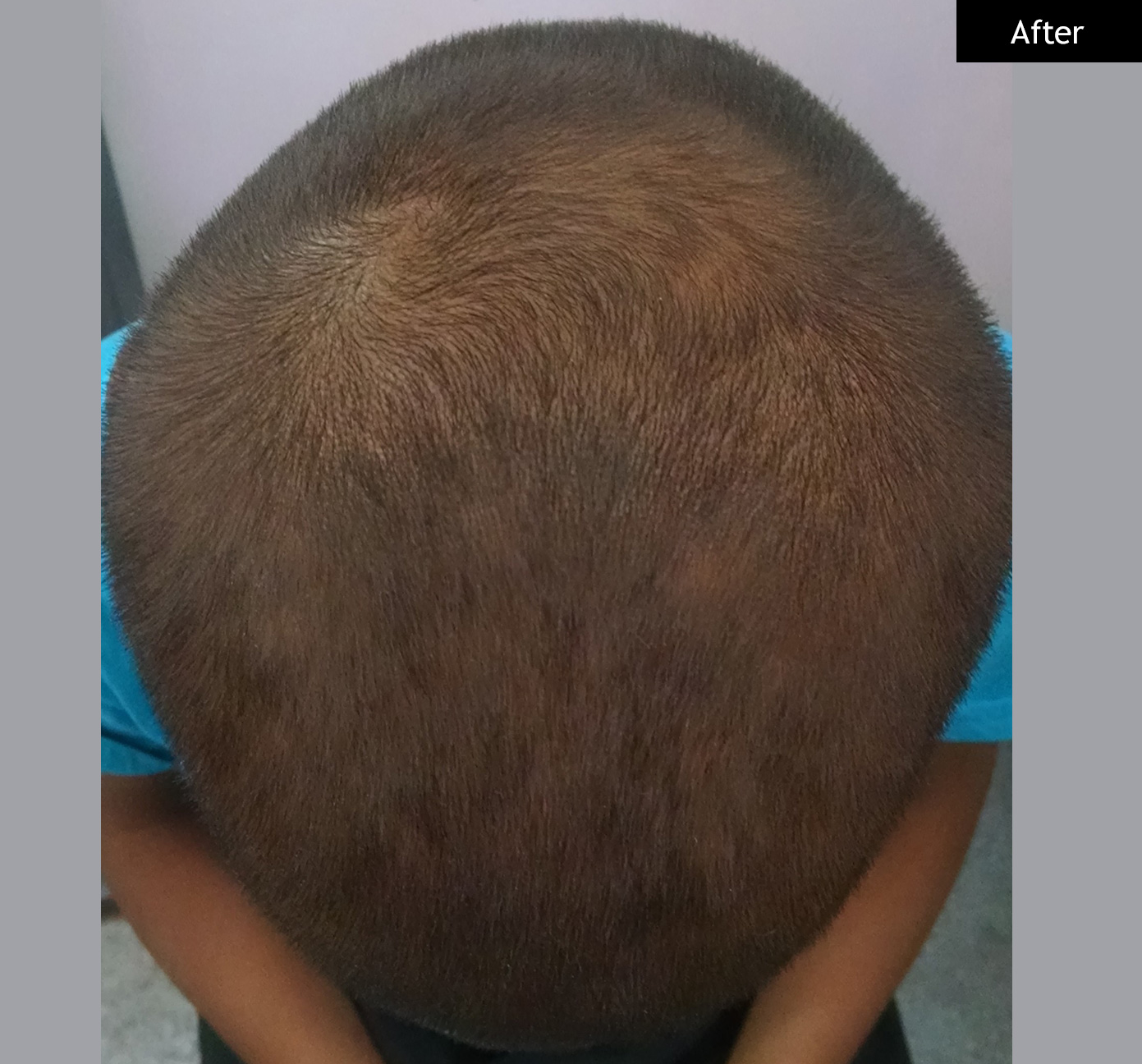 After: Alopecia areata, regrowth after treatment
