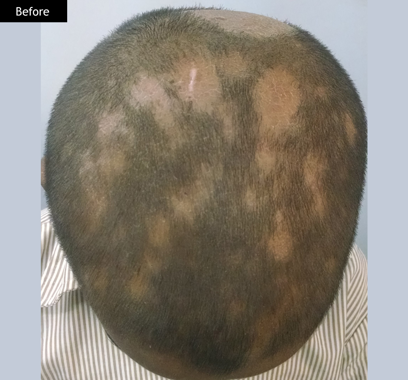 Before: Alopecia areata, regrowth after treatment