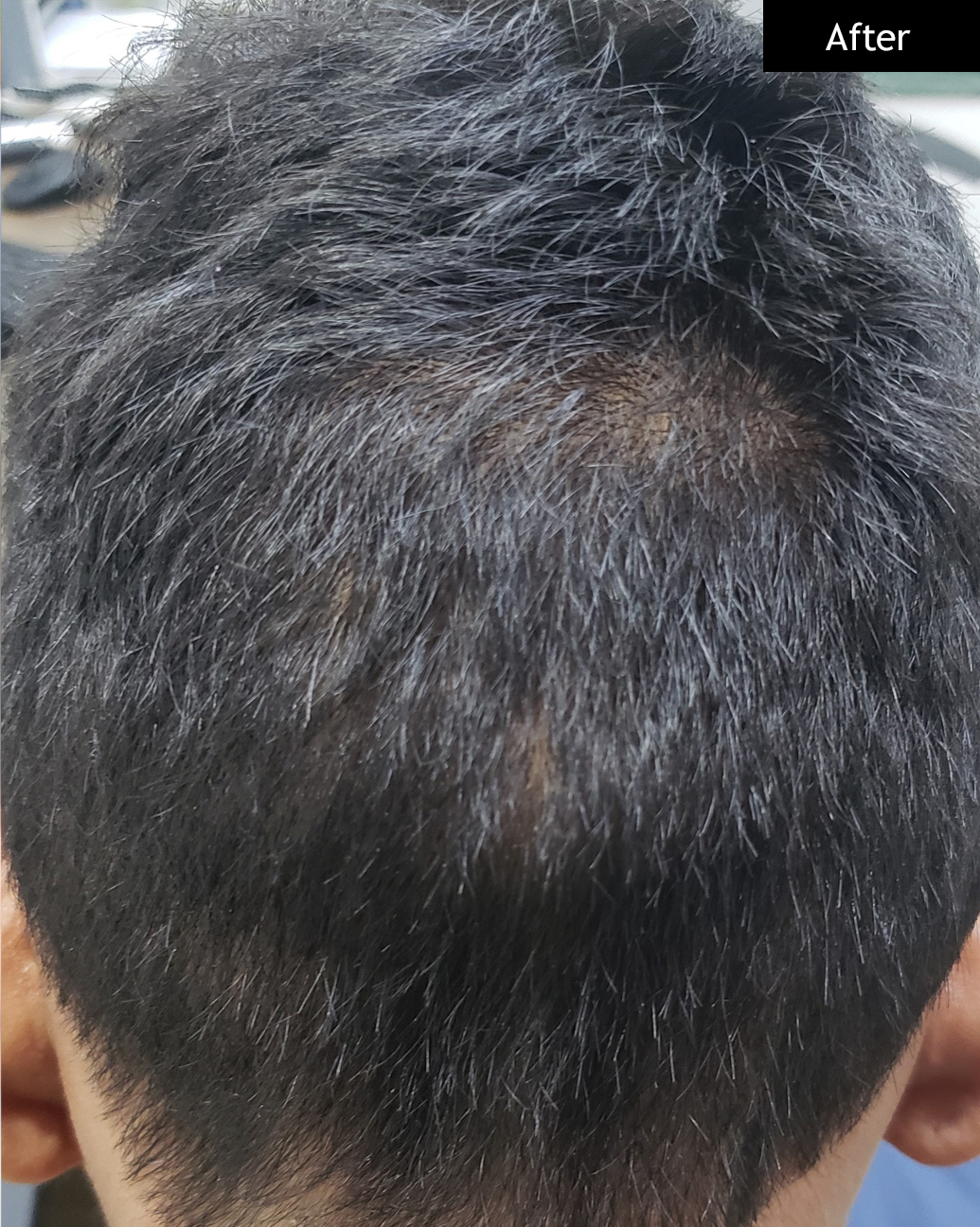 After: Alopecia areata, scalp patch regrowth