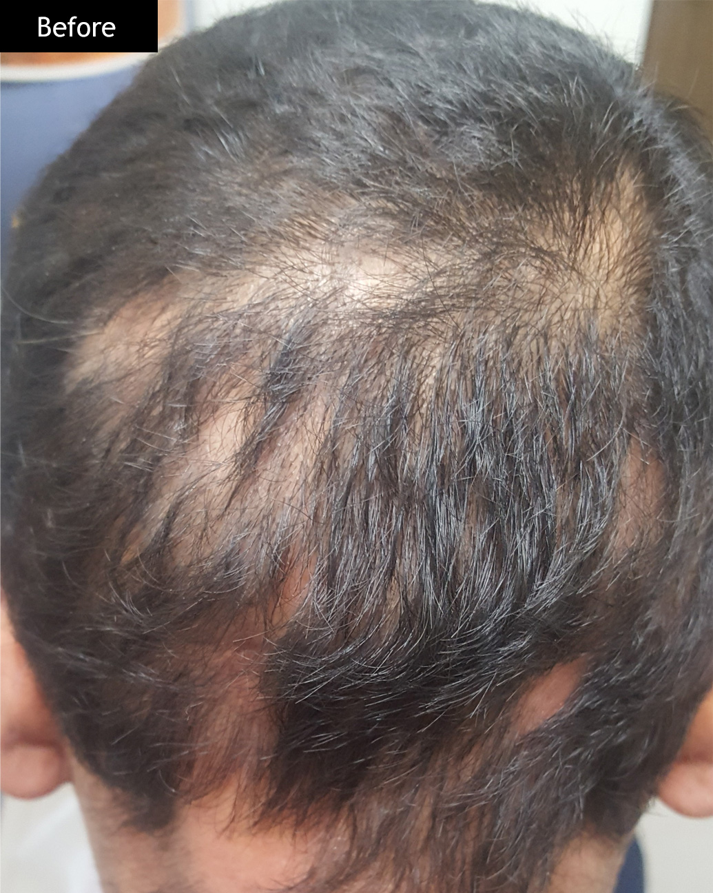 Before: Alopecia areata, scalp patch regrowth