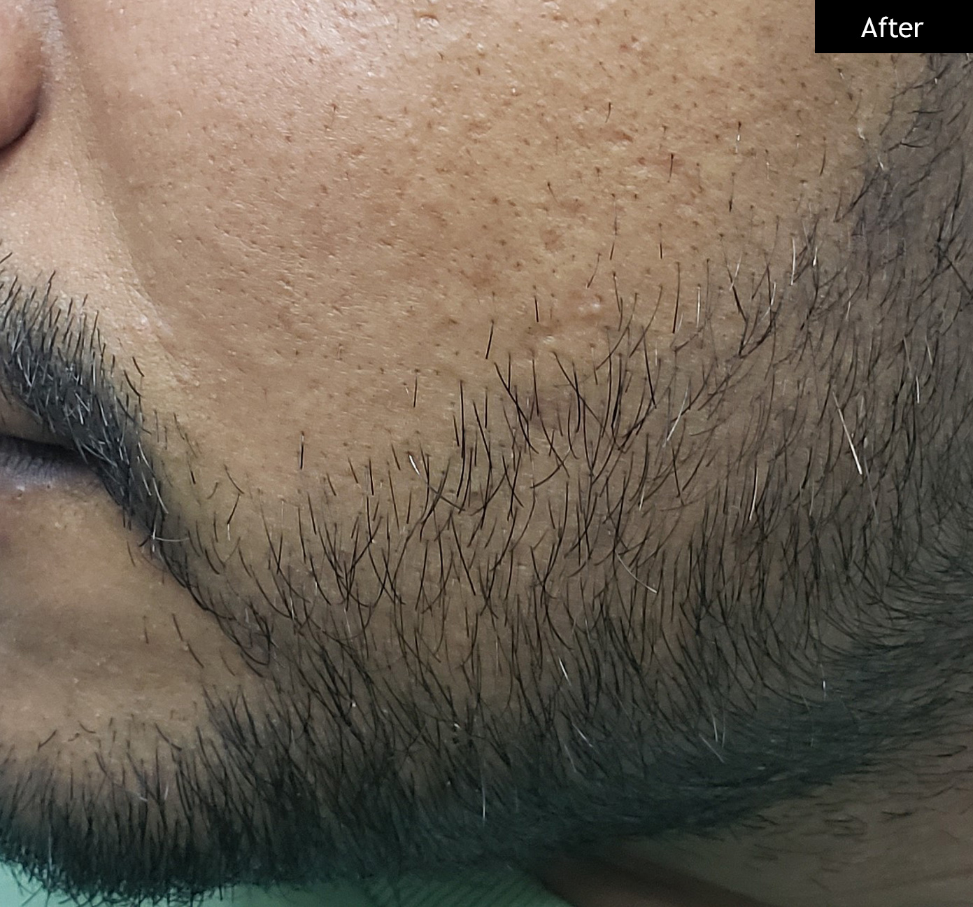 After: Post-chickenpox mark reduction