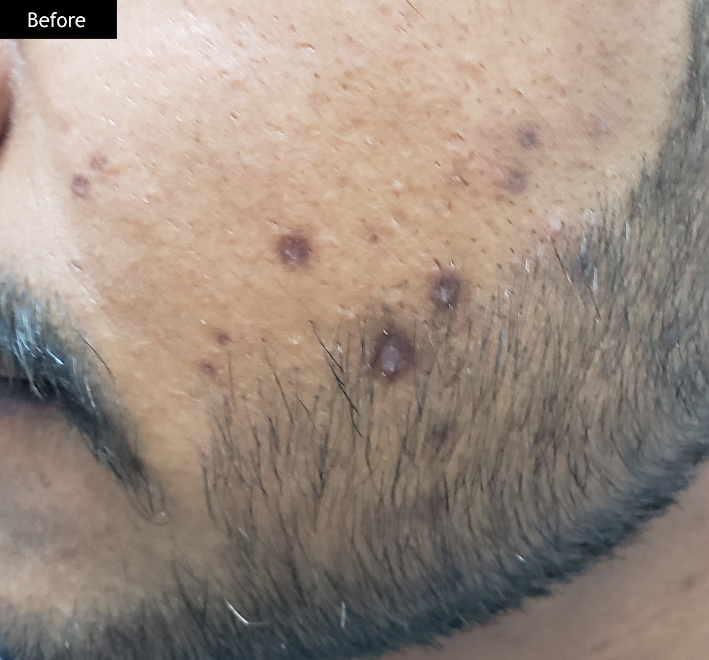 Before: Post-chickenpox mark reduction