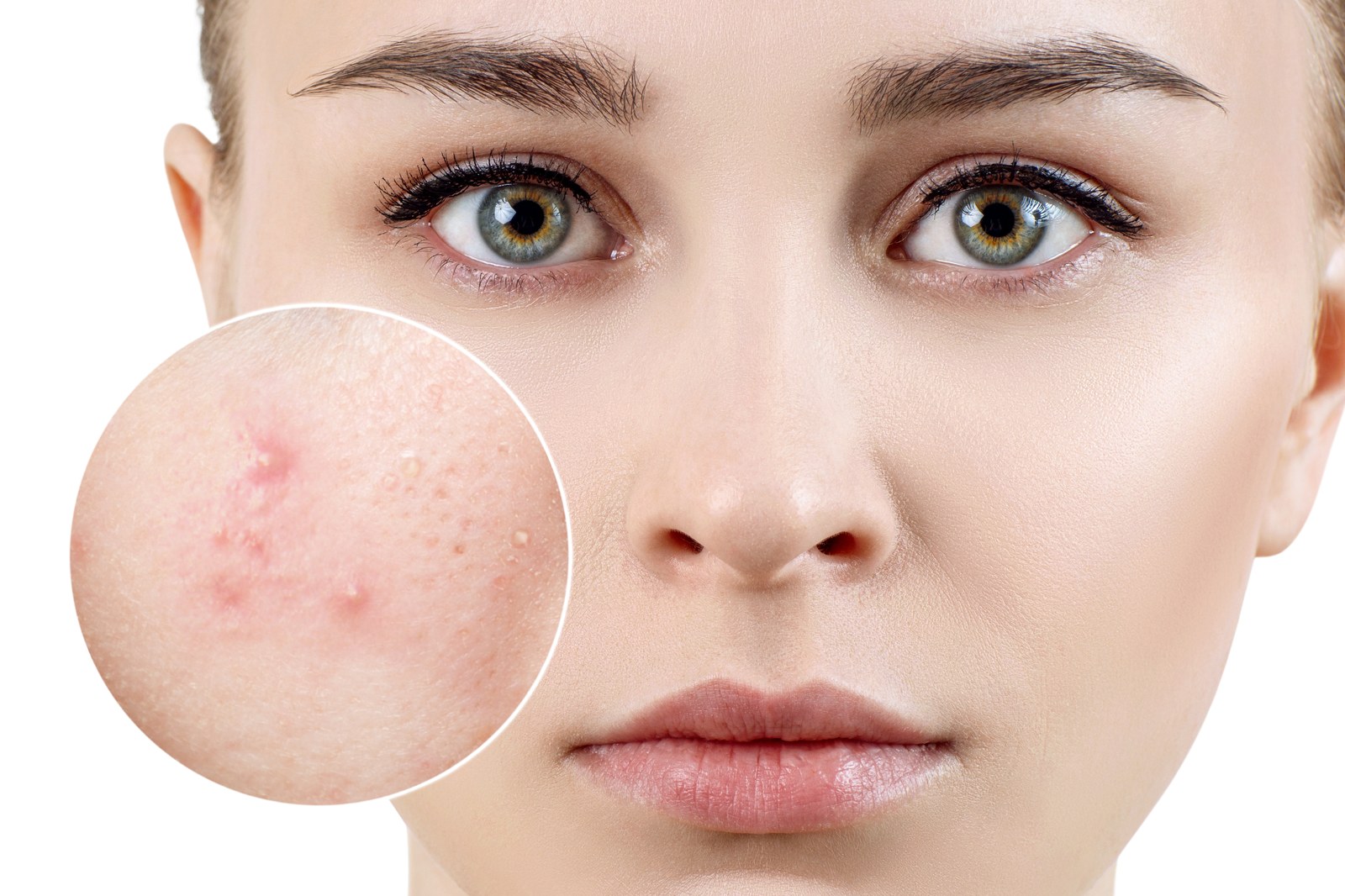 Acne Treatment