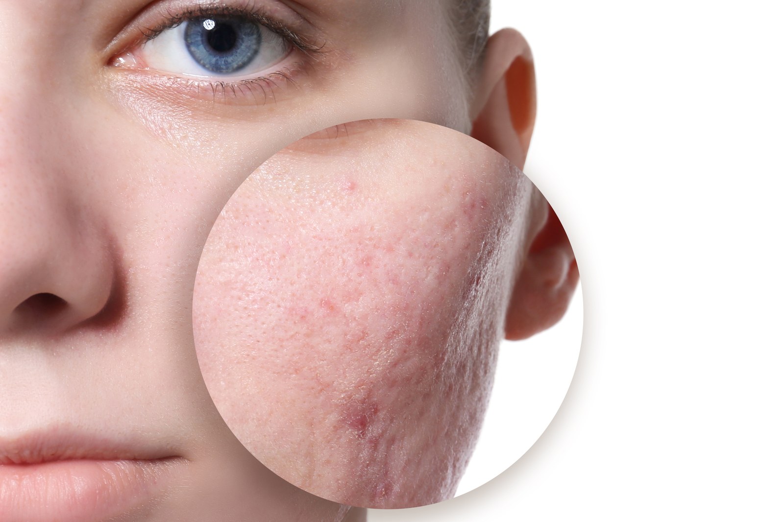 Acne Scar Treatment