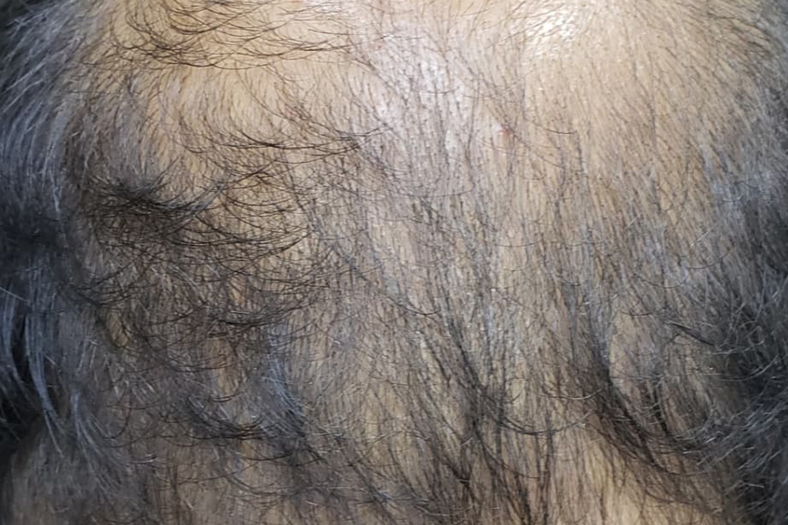 Baldness & Pattern Hair Loss