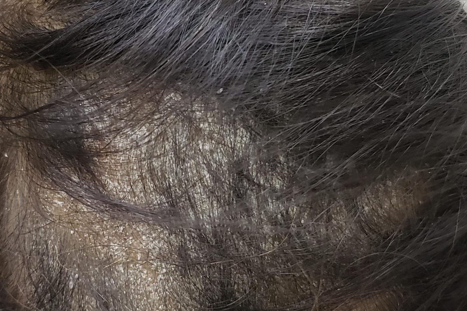 Dandruff & Scalp Care