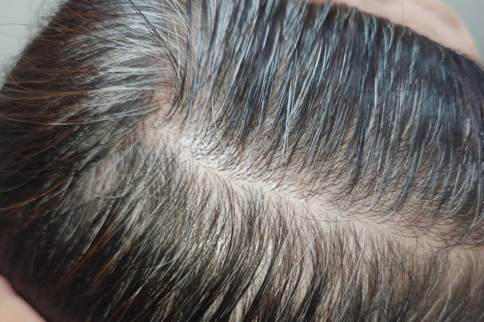 Premature Greying