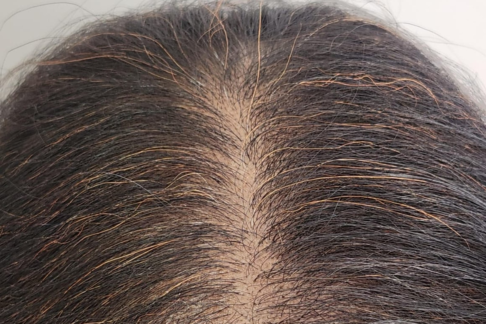 Hair Fall Treatment