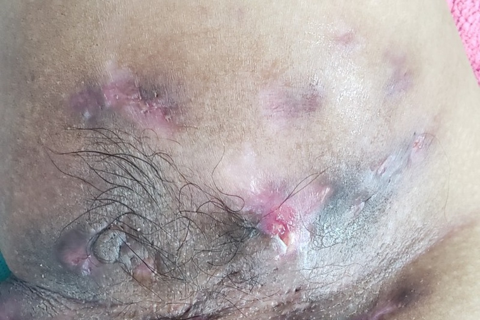 Hidradenitis Suppurativa Treatment