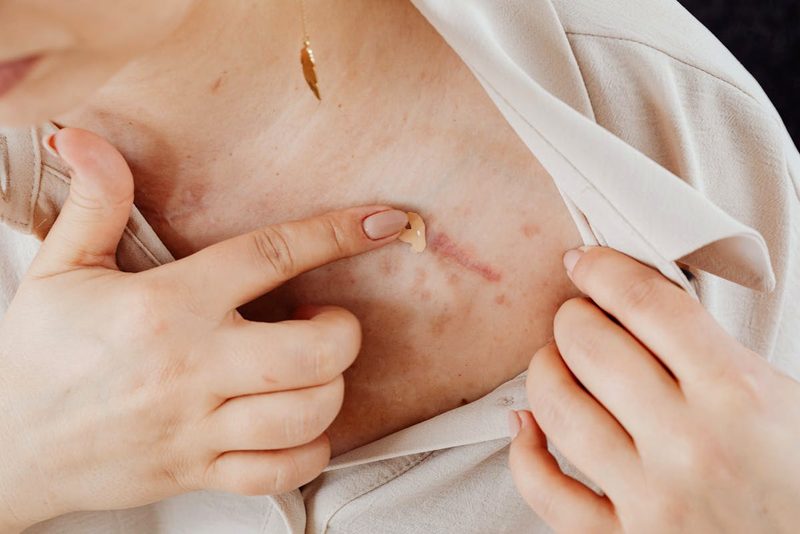 Keloid & Scar Treatment