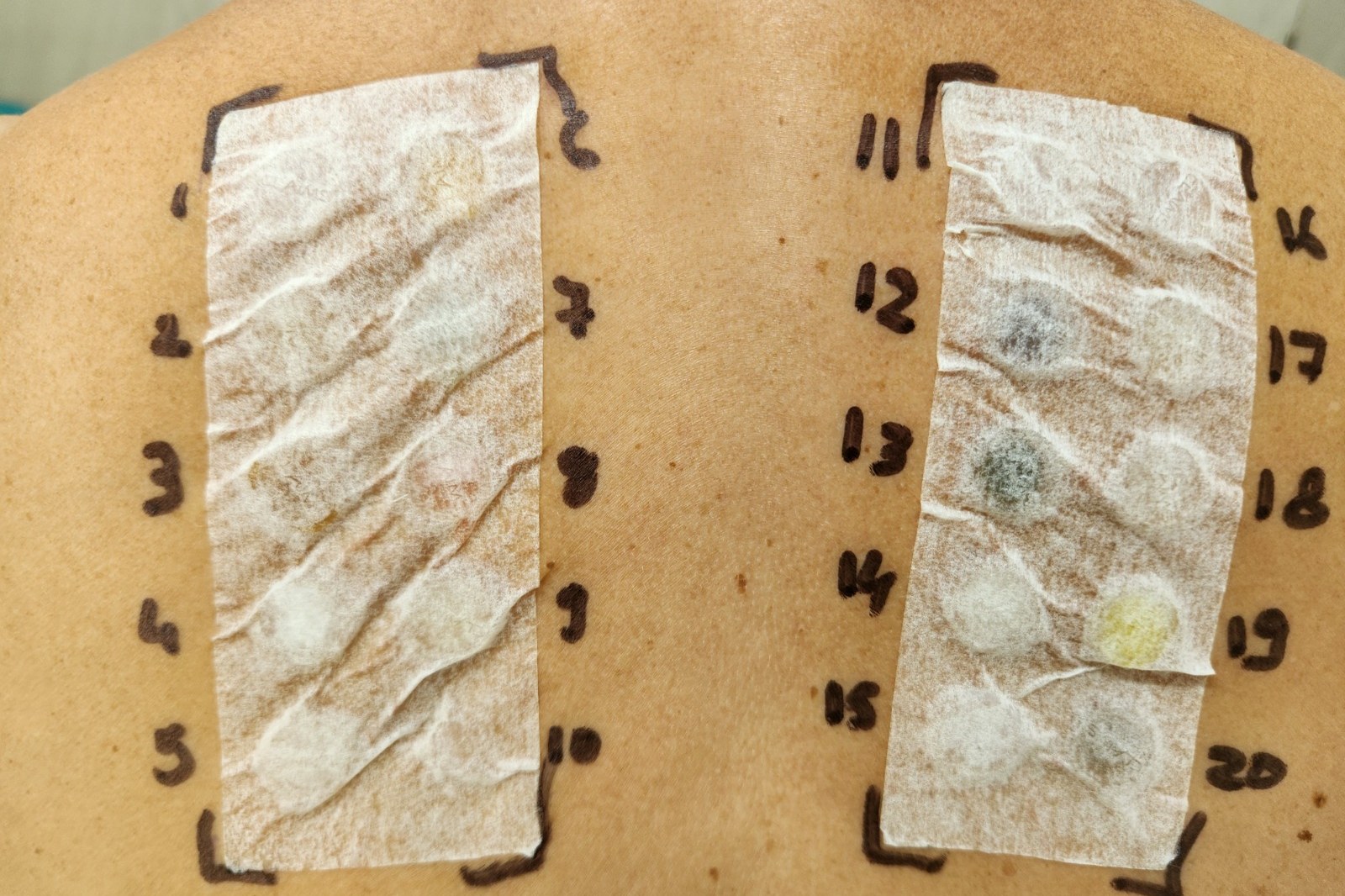 Patch Testing for Allergies