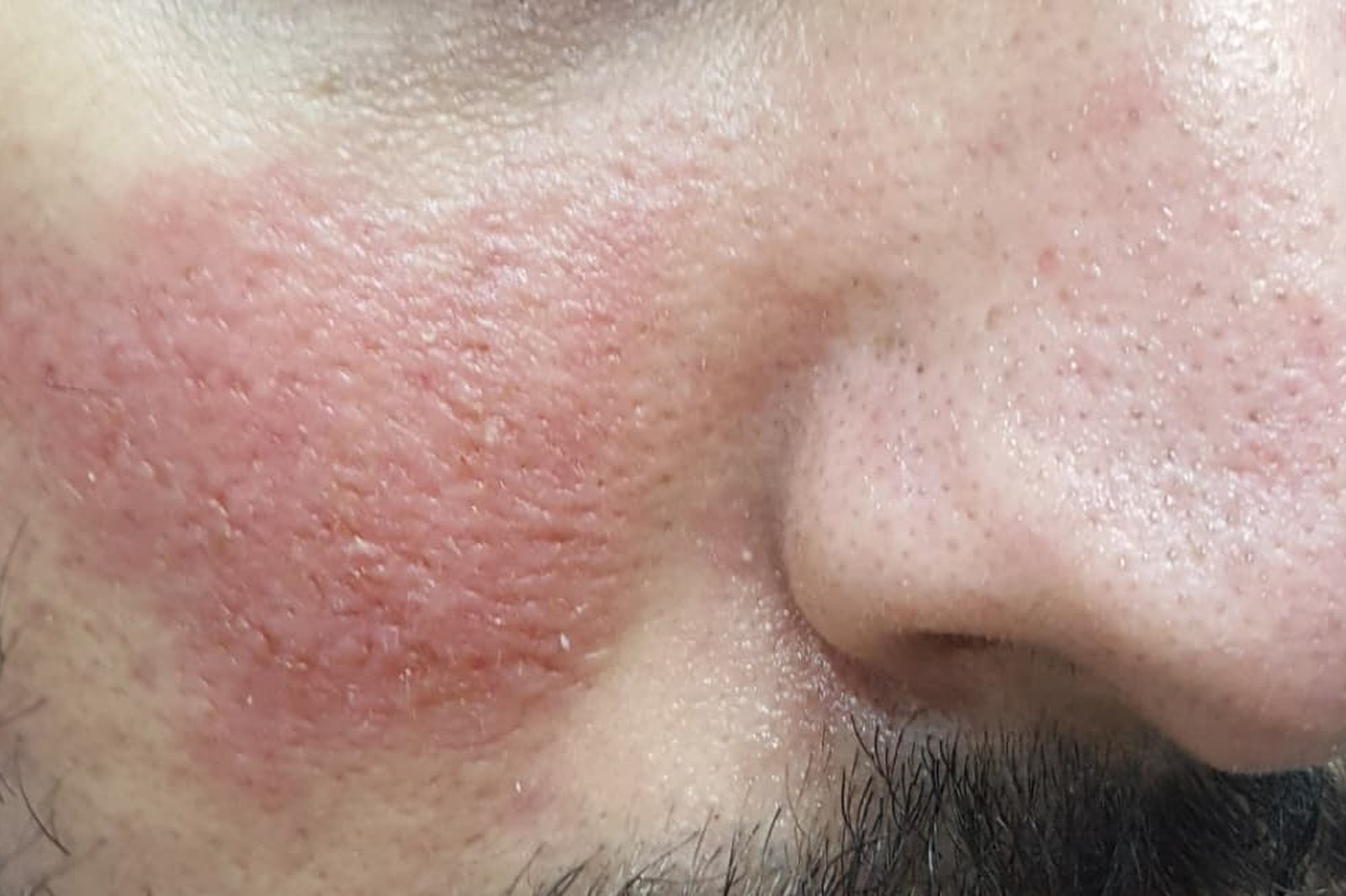 Rosacea Treatment