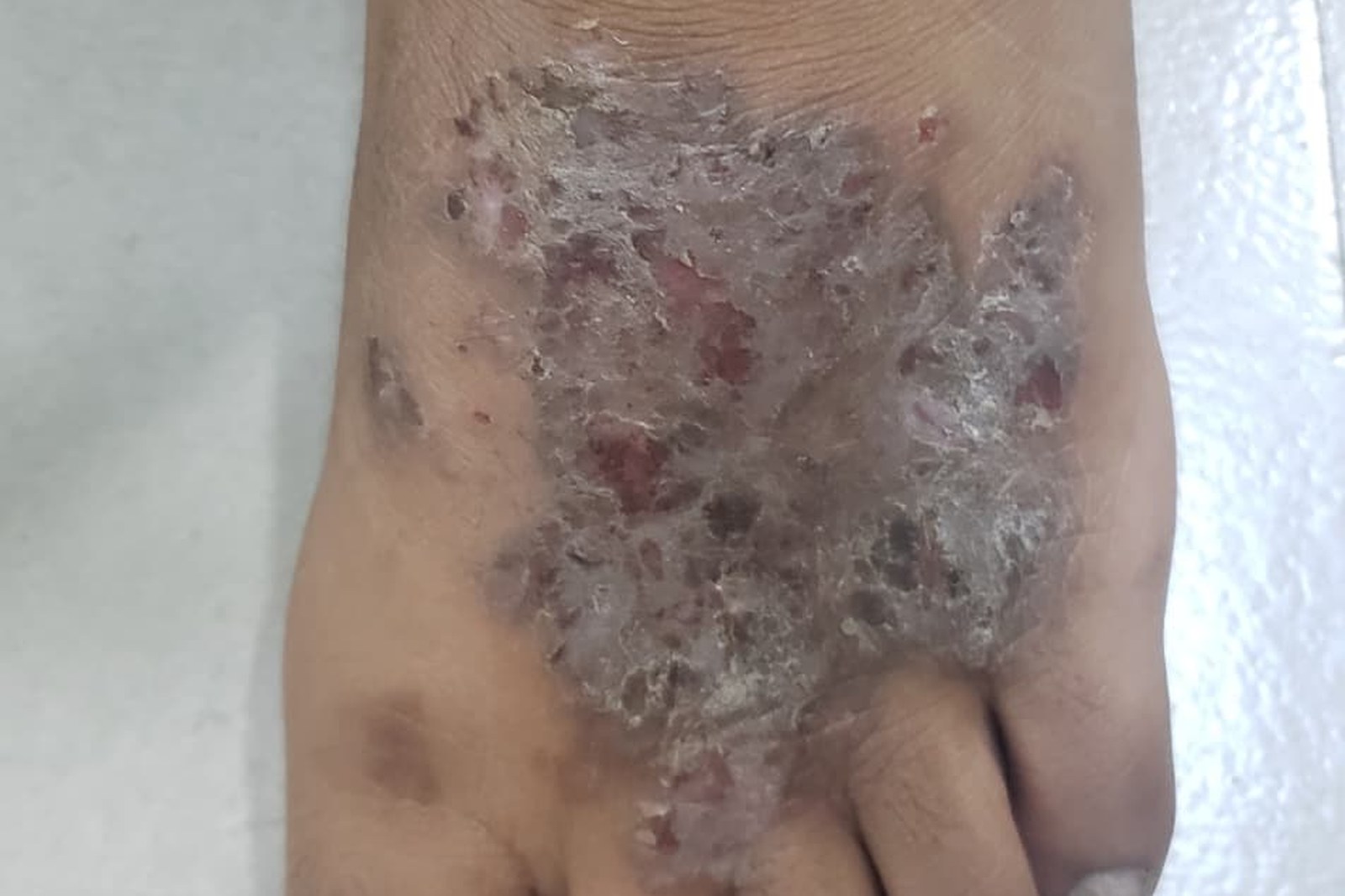 Eczema, Psoriasis & Dermatitis