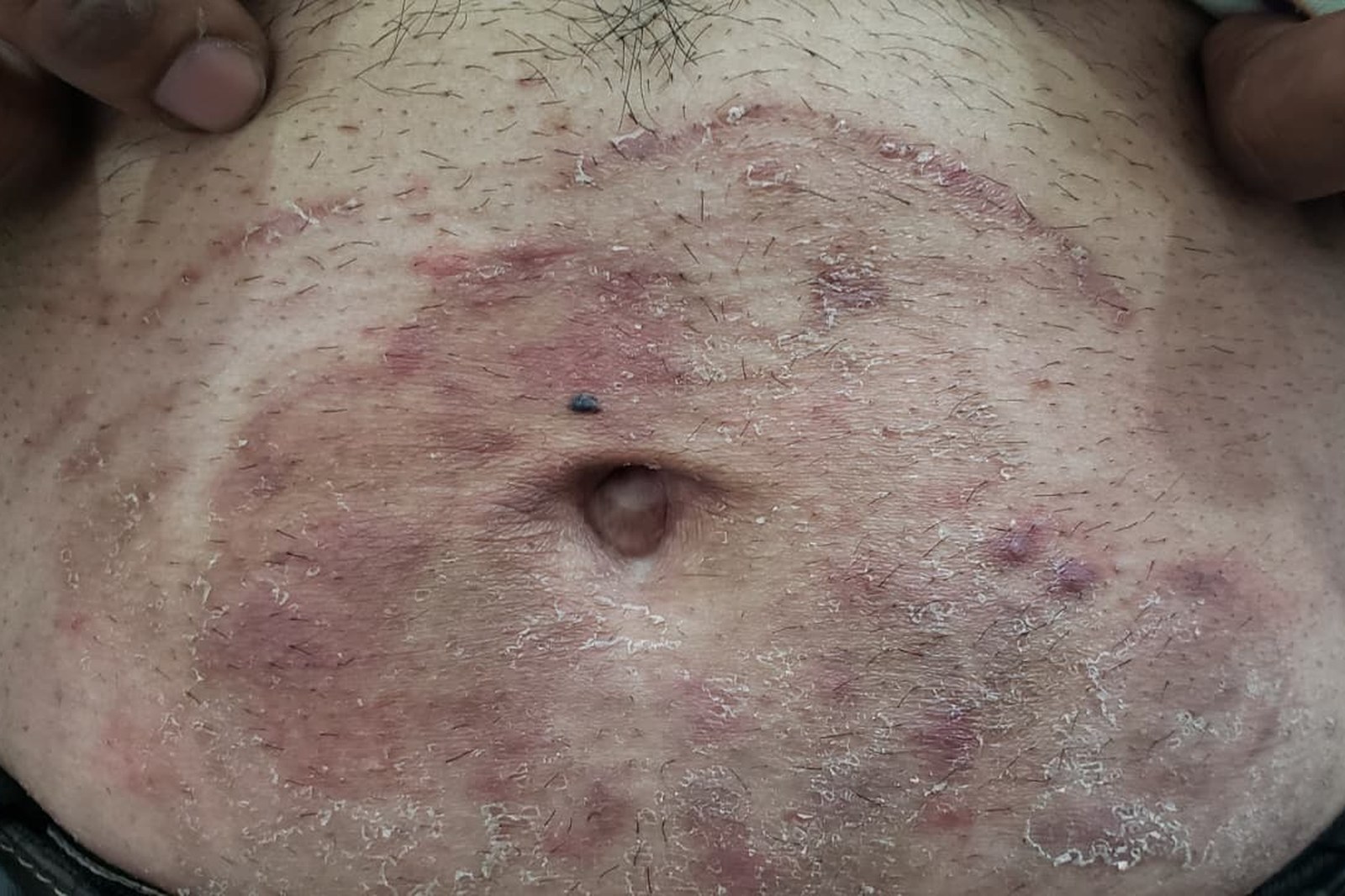 Skin Infections