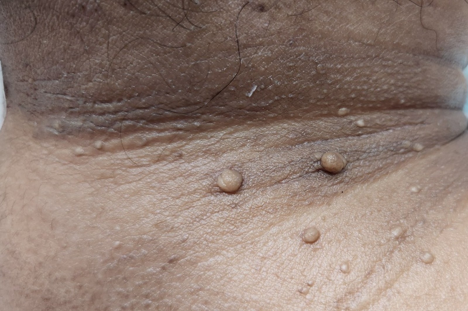 Skin Tags, Moles & Warts