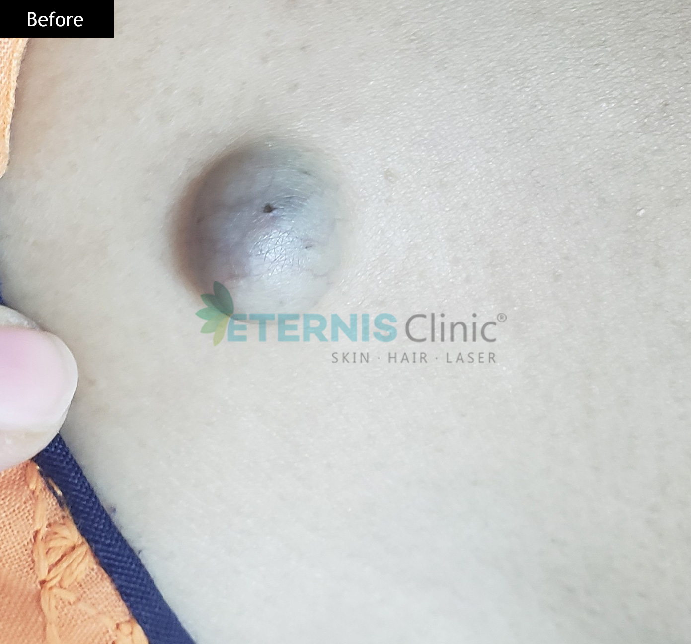 Cyst-Removal