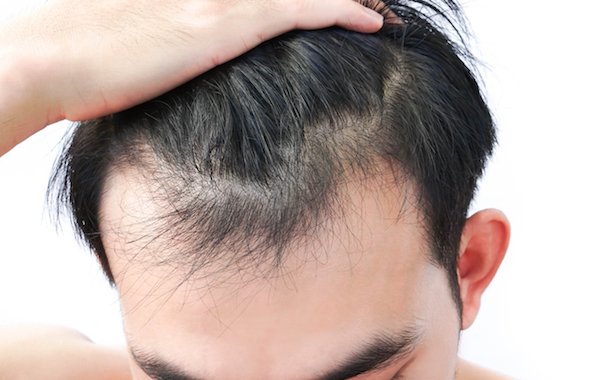 Sparse Hair decreased hair growth definition and causes