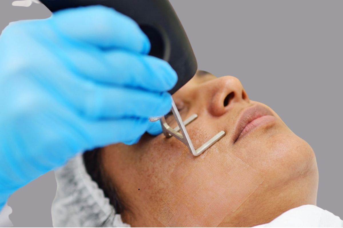 Acne Treatment in Pune by Eternis Skin Clinic