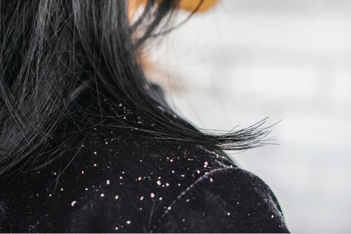 Dandruff, Seborrheic Dermatitis Treatment in Pune at Eternis Skin Clinic