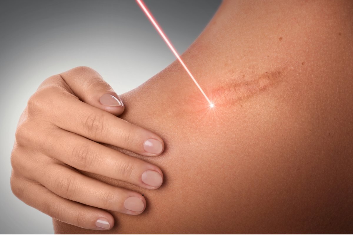 Keloid Scar Treatment in Pune at Eternis Skin Clinic