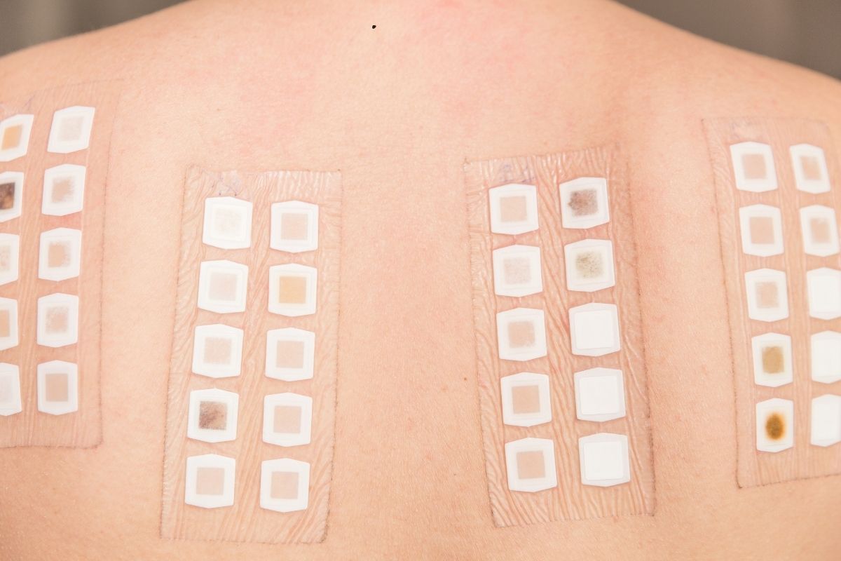 Patch Testing for Allergies in Pune at Eternis Skin Clinic