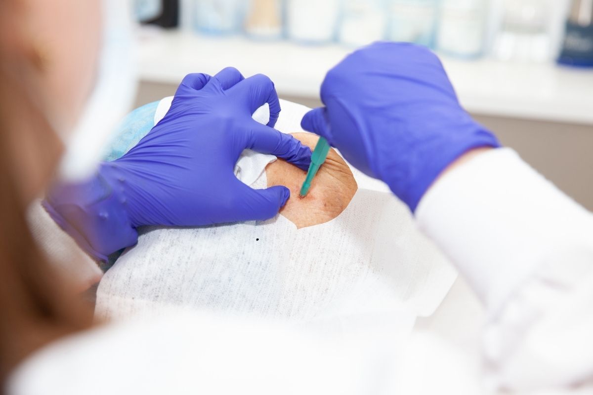 Skin Biopsy Test in Pune at Eternis Skin Clinic